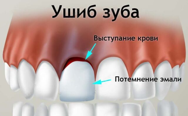 Ушиб зуба